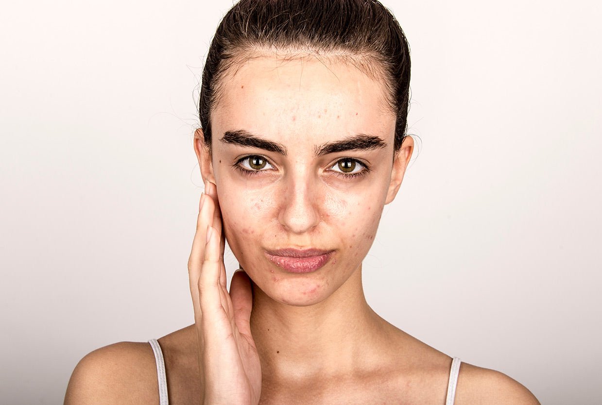 Junge Aknehaut – was nun? - cobicos