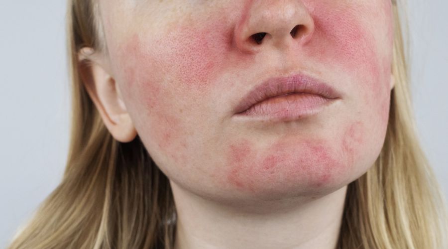 Wie pflege ich meine Rosacea Haut?