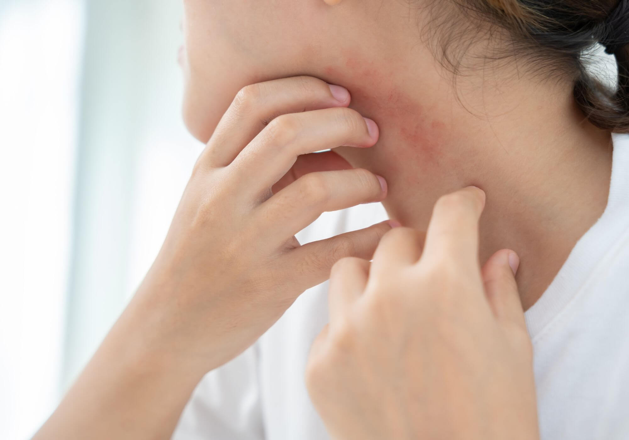 junge Frau kratzt sich am Hals mit roten, trockenen Hautstellen