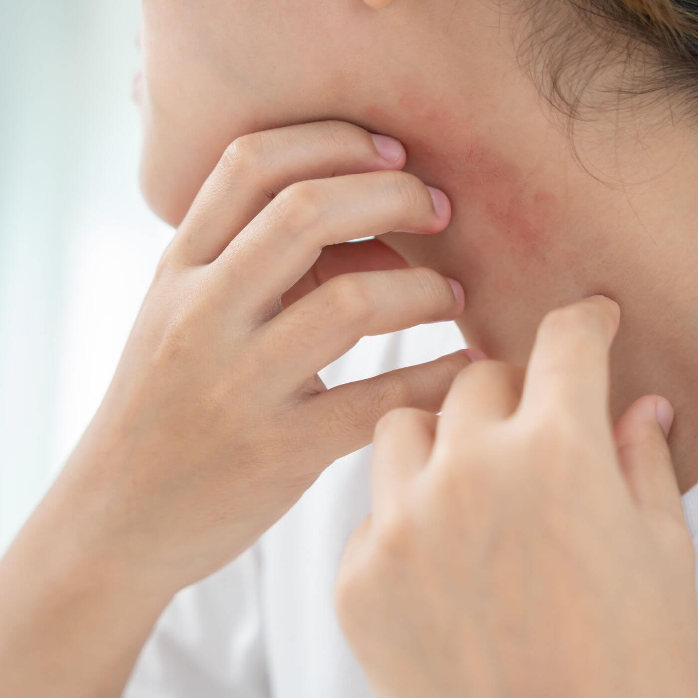 junge Frau kratzt sich am Hals mit roten, trockenen Hautstellen