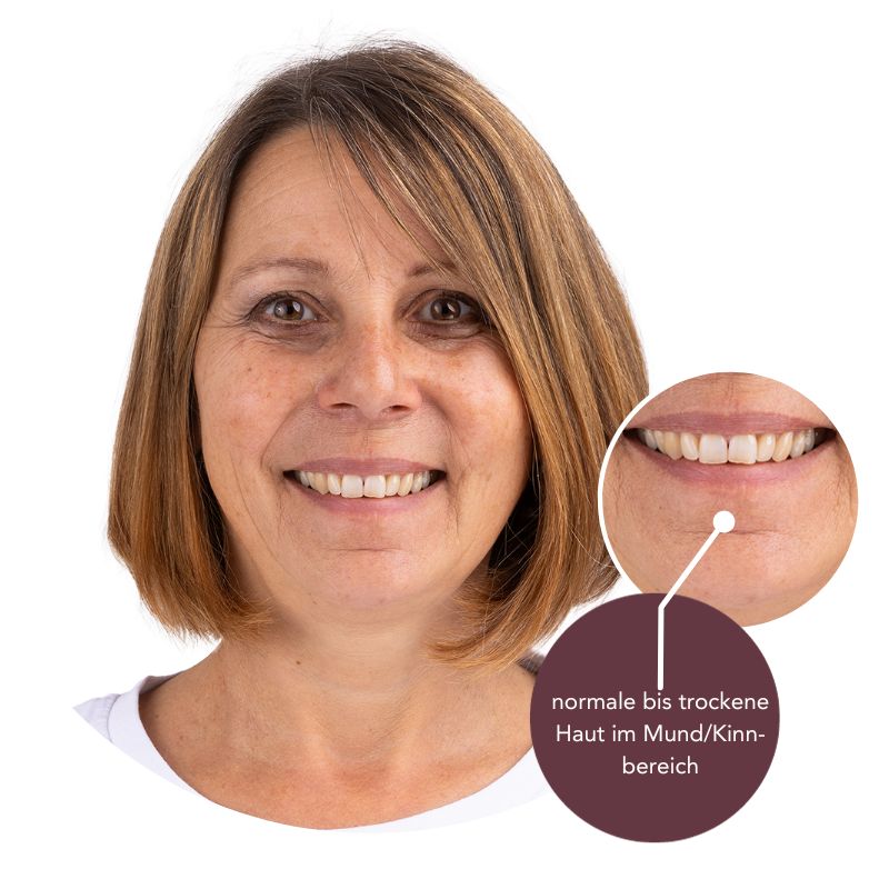 Hauttyp mit normaler bis trockener Haut im Mund- und Wangenbereich